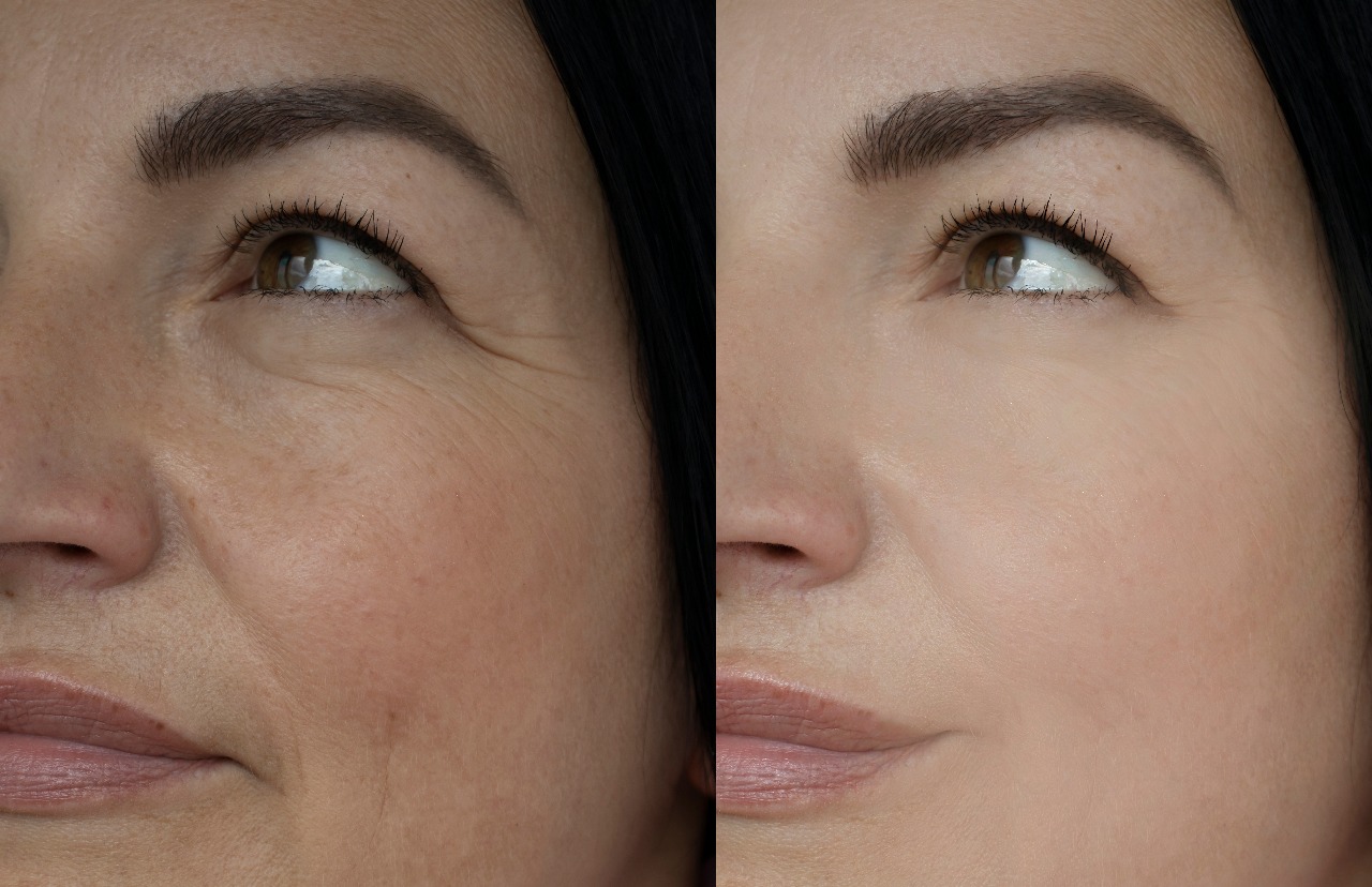 Antes e depois do Sérum Rejuvenescedor LUMINA ORO 24K